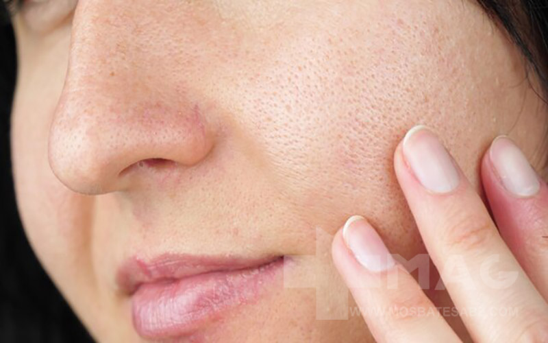 علت باز شدن منافذ پوست