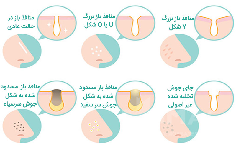 انواع منافذ باز صورت