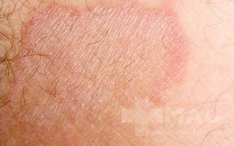 علائم اگزمای دستگاه تناسلی زنان و مردان 