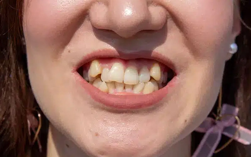 گاز گرفتن زبان در خواب