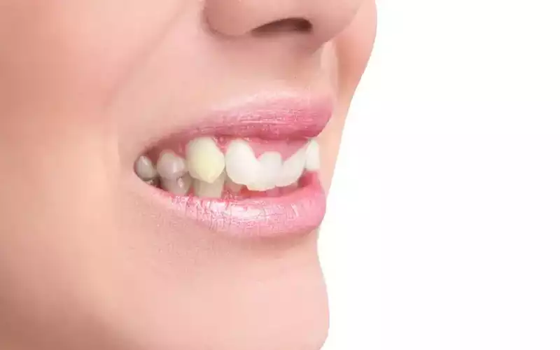 تغییر رنگ دندان نیش چیست و چرا اهمیت دارد؟