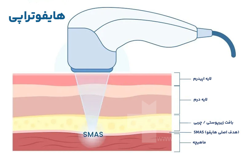 عملکرد هایفوتراپی در بازسازی کلاژن