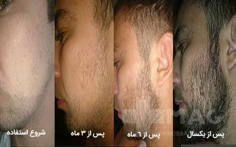 تاثیر ماینوکسیدیل بر رویش ریش