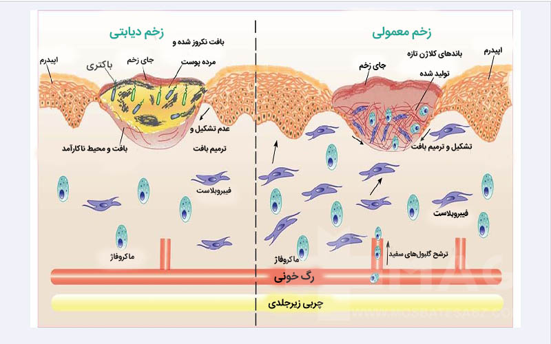 علت دیر خوب شدن زخم دیابتی