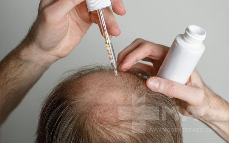 انواع ماینوکسیدیل چیست