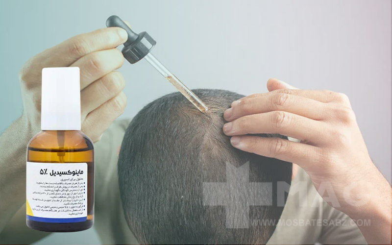 نحوه استفاده از ماینوکسیدیل 5 درصد