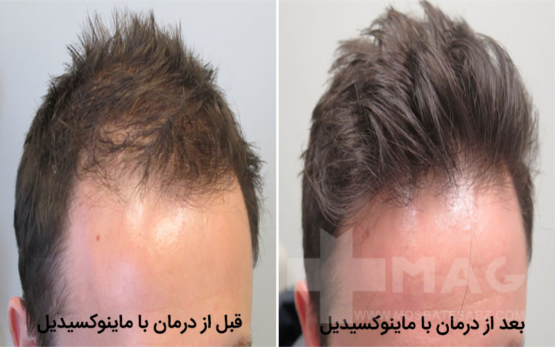 درمان ریزش موی جلوی سر آقایان با ماینوکسیدیل