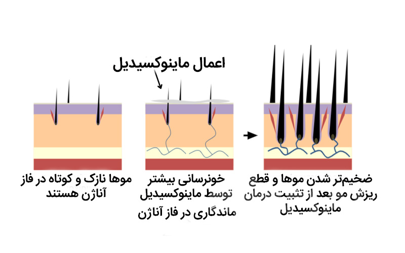 اثرگذاری میانوکسیدیل بر تار مو