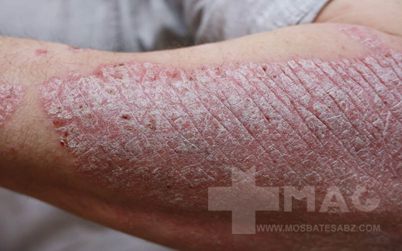 علت دیر خوب شدن زخم پسوریازیس