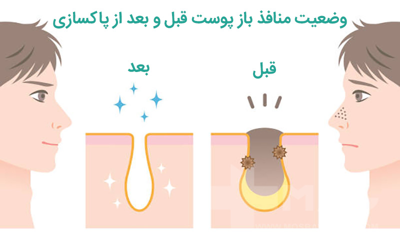 وضعیت منافذ باز پوست قبل و بعد از پاکسازی