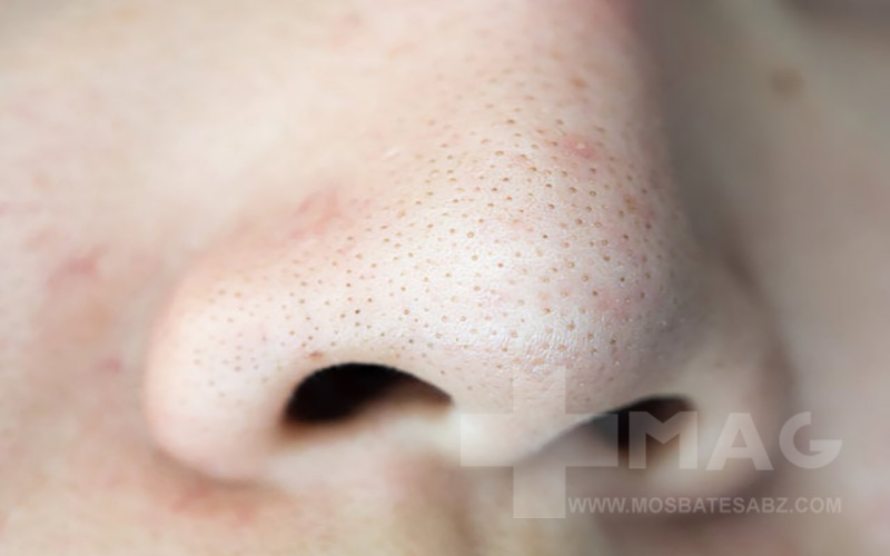 روش های پزشکی درمان منافذ باز صورت