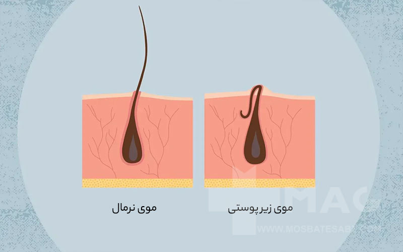 اسکراب برای خارج کردن موی زیر پوستی