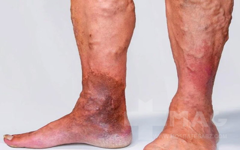 علت دیر خوب شدن زخم ساق پا