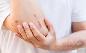 علت دیر خوب شدن زخم