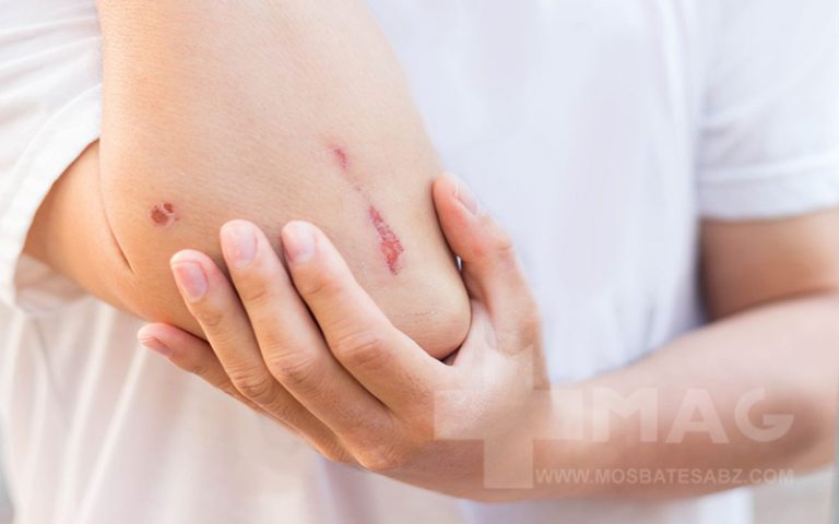 علت دیر خوب شدن زخم