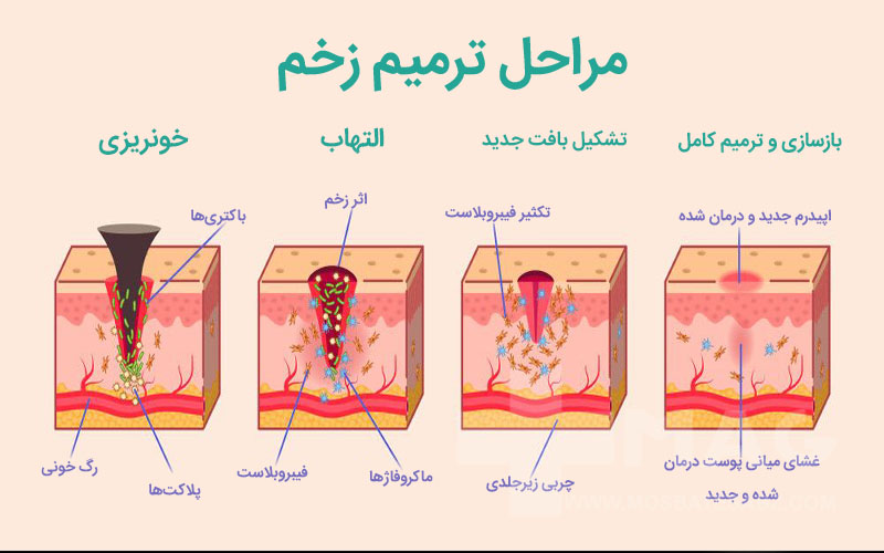 مراحل ترمیم زخم در بدن