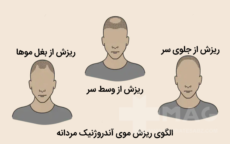 الگوی ریزش موی مردانه
