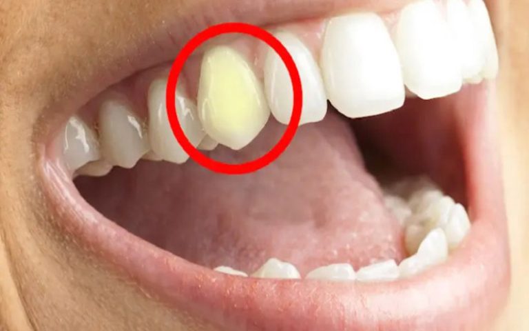 علت تغییر رنگ دندان نیش