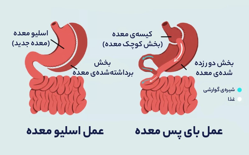فرق اسلیو معده با بای پس معده - دکتر محمدتقی رضایی جراح چاقی