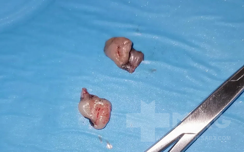 گوشت اضافه مقعدی بریده شده