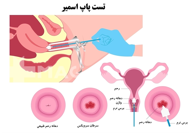 تشخیص دهانه رهان سرطانی و سالم در تست پاپ اسمیر