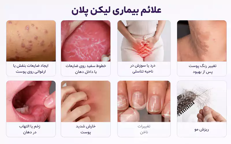 علائم بیماری لیکن پلان